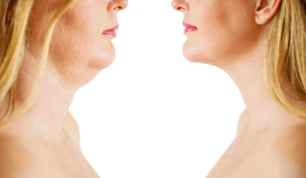 Double Chin treatment Hammersmith and Fulham before and after results