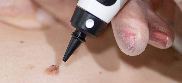 After Skin Tag Removal Hammersmith and Fulham