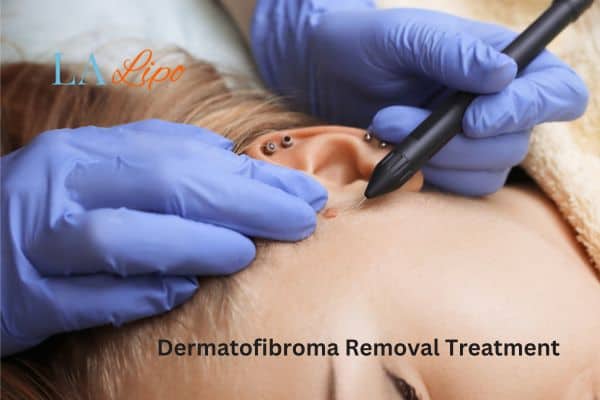 Dermatofibroma Removal Treatment Hammersmith and Fulham