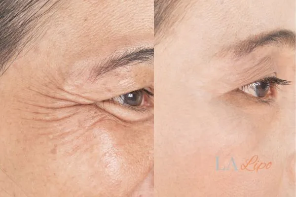 Before and after results of woman - HI-fu wrinkles reduction treatment Hammersmith and Fulham