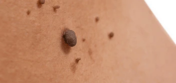 image of a skin tag Hammersmith and Fulham