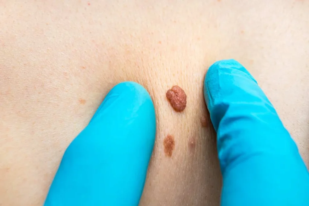 Consultant examining a skin tag Hammersmith and Fulham