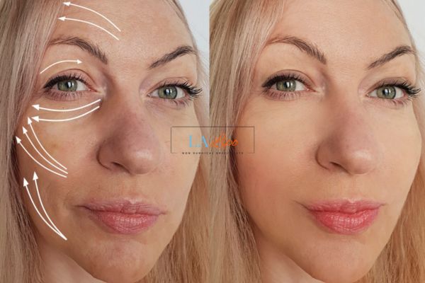 Morpheus 8 results Hammersmith and Fulham face lift.
