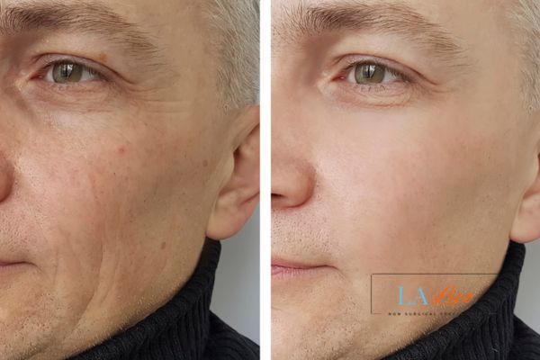 See the amazing results of Morpheus8 Treatment Hammersmith and Fulham!