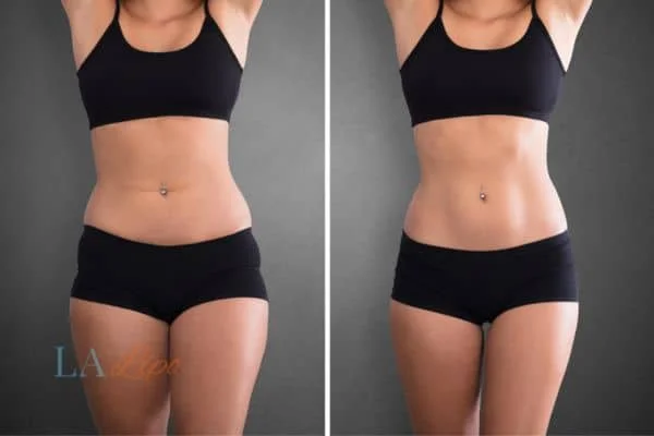 before and after results of non-surgical treatment to help a woman's body image and mental health Hammersmith and Fulham