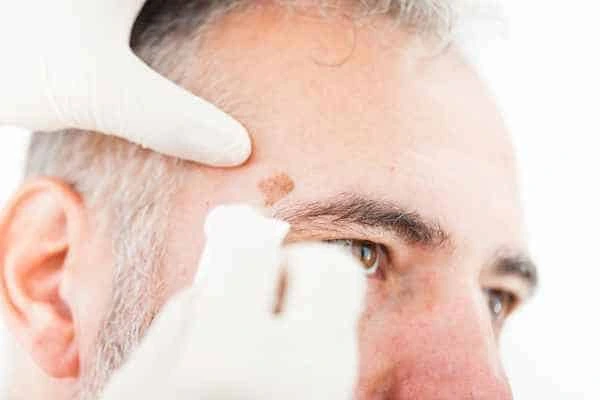 Age spots and elderly people Hammersmith and Fulham what is the link?