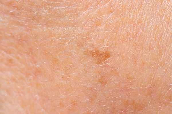 close up picture of age spots Hammersmith and Fulham