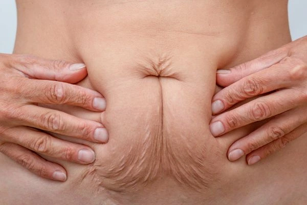 Should I Combine Diastasis Recti Treatment with Body Contouring for Better Results Hammersmith and Fulham?